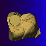 tooth with cavity